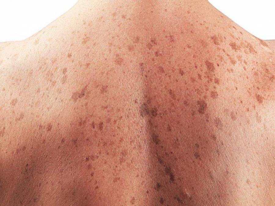 Câncer de pele melanoma como prevenir e diagnosticar precocemente Portal Ururau Site de Câncer de pele melanoma como prevenir e diagnosticar precocemente Portal Ururau Site de